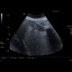 Gallstones, cholecystolithiasis, sludge, twinkling artifact: US - Ultrasound